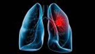 إنفوجراف.. السرطانات الأكثر انتشارا في أمريكا أبرزها الرئة