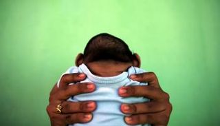 طفل مصاب بصغر حجم الرأس بسبب زيكا