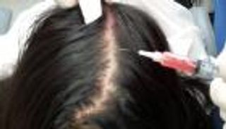 8 حقائق عن استخدام" البلازما" في علاج الصلع