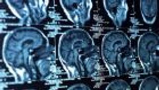 تطوير ماسح ضوئي للمخ يتنبأ بمدى نجاح فقدان الوزن