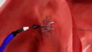 بالفيديو.. "كورفيا".. جهاز جديد لإنقاذ مرضى القلب من الموت