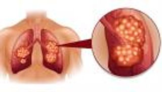 8 علامات تدل على إصابتك بسرطان الرئة.. حتى لو لم تكن مدخنا