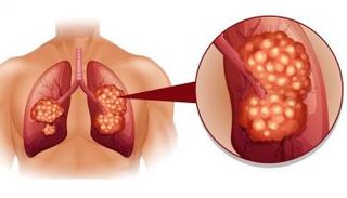 20% من وفيات سرطان الرئة لم يكونوا مدخنين