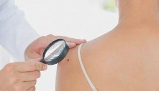 سرطان الجلد يقتل الآلاف كل عام