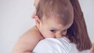 طفل يعاني من حساسية - تعبيرية عن الطفح الجلدي شائع بين الأطفال