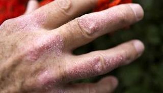 مرضى الصدفية أكثر عرضة للنوبات القلبية والوفاة