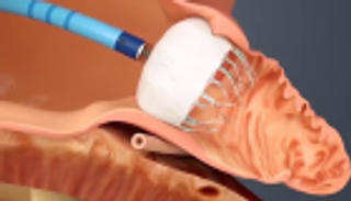 فريق "صحة دبي" ينجح في زراعة "فلتر" لمنع الجلطات الدماغية