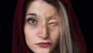 بالصور.. زفاف إحدى ضحايا الحرق بماء النار في إيران