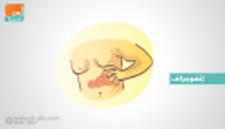 إنفوجراف.. مرض "الحزام الناري" أسبابه وطرق الوقاية