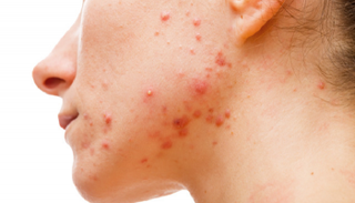 وصفات للتخلص من حبوب الوجه نهائياً