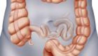 هل القولون يسبب دوخة؟