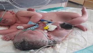 التوأم السيامي الفلسطيني