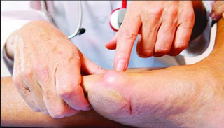 العلاج يعتمد على إدارة الأعصاب والجروح في القدم