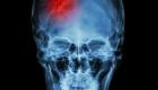 بريطانيا تعالج السكتة الدماغية.. قريبًا