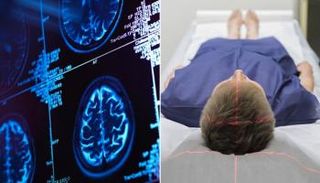 سائل في المخ يكشف سر التوحد