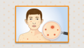 إنفوجراف.. الجديري المائي.. عدو الأطفال في تقلبات الفصول