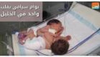 ولادة توأم ملتصق من الصدر والبطن وبقلب واحد في الخليل