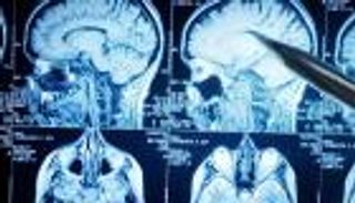 قبعة كهربائية تزيد فرص نجاة مرضى سرطان المخ 