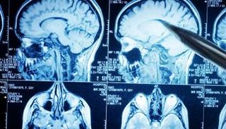 أمل جديد للعلاج من سرطان المخ