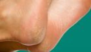 7 أسباب لتقشر القدمين وتشققها .. كيف تتجنبها؟