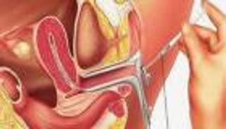 "رحم اصطناعي" لبقاء الأطفال المبتسرين أحياء
