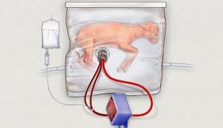 الرحم الصناعي ينقذ آلاف الأطفال