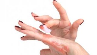 إكزيما الجلد