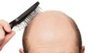 علماء يكتشفون علاجا "ثوريا" للصلع بالصدفة