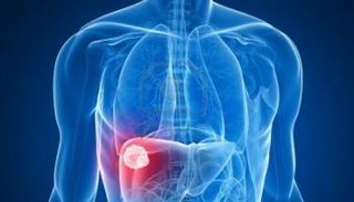 مرض الكبد الدهني 