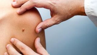  ارتفاع احتمالية اصابتك بسرطان الجلد متوقف على تلك العوامل الـ 6