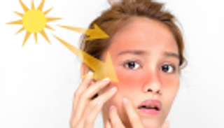 8 وصفات طبيعية لعلاج حروق الشمس.. وطريقتان لتهدئة الآلام