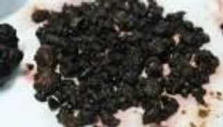 الصين.. استخراج 200 حصوة في كبد ومرارة سيدة