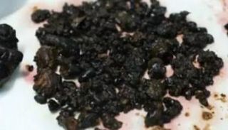 إزالة 200 حصوة من كبد ومرارة سيدة 