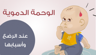 الوحمة الدموية عند الرضع وأسبابها