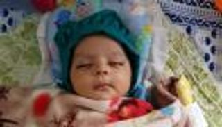 بالصور.. أطباء هنود ينتزعون 7 أسنان من فم طفل عمره شهر