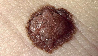 سرطان الخلايا الصبغية 