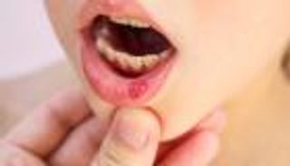 قرحة الفم.. 8 نصائح لتخفيف الألم والتعجيل بالشفاء