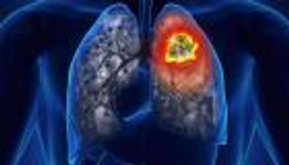 دواء لضغط الدم يزيد مخاطر الإصابة بسرطان الرئة