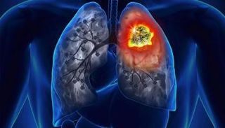 دواء لضغط الدم يزيد مخاطر الإصابة بسرطان الرئة