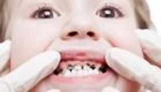 أعشاب طبيعية لعلاج آلام تسوس الأسنان اللبنية عند الأطفال