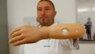 ذراع صناعية متصلة بالعظام.. أمل جديد لمبتوري الأطراف