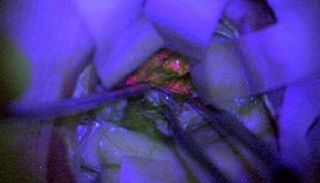 مادة كيميائية وردية اللون تسهل جراحات سرطان المخ