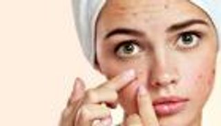 أطباء: حَب الشباب لا علاقة له بالأطعمة