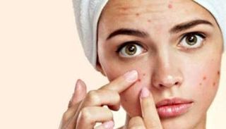 حب الشباب - صورة أرشيفية