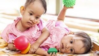 فصل توأم ملتصق بجراحة استمرت 6 ساعات في أستراليا