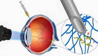 روبوت صغير يسهل دخول الدواء في العين - أرشيفية