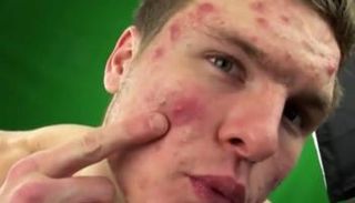 منتجو الصابونة الجديدة يعدون بالقضاء على حب الشباب خلال أسبوعين