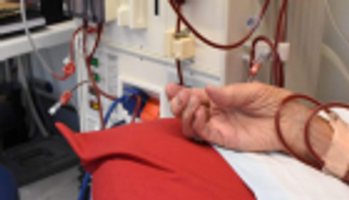 علماء يحددون 35 جينا تسبب مرض الكلى المزمن