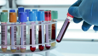 ارتفاع عدد الإصابات الجديدة بفيروس الإيدز في شرق أوروبا 