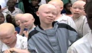 أطفال مصابون بالمهق